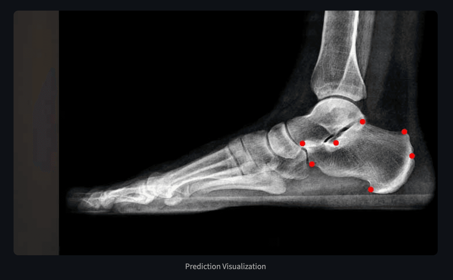 Automated Landmark Detection for Calcaneus